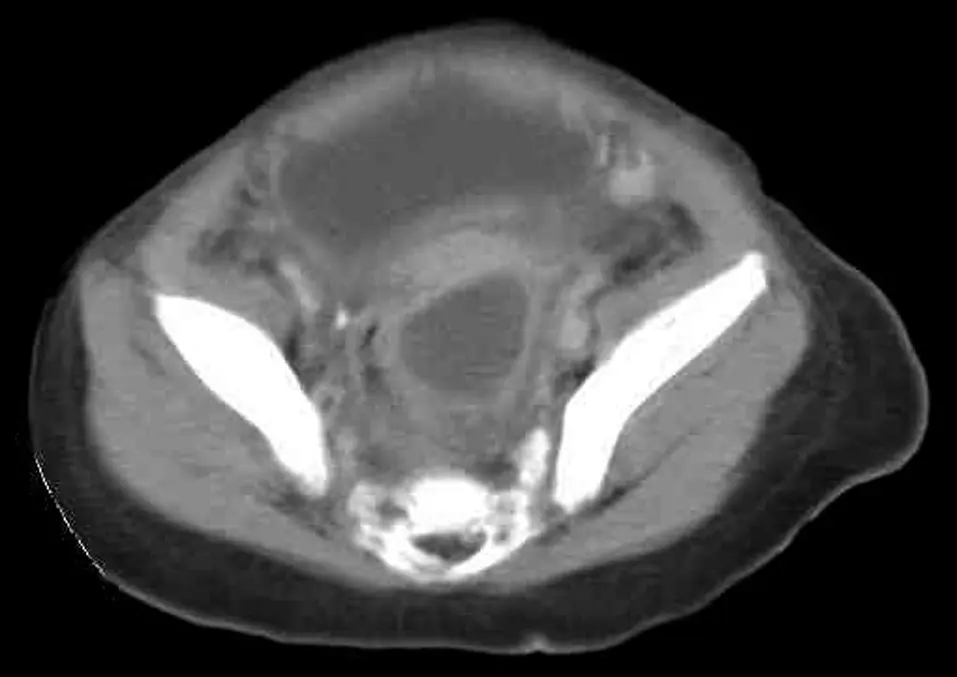 historia clinica pediatrica real apendicitis - Cómo puedo saber si mi hijo tiene apendicitis