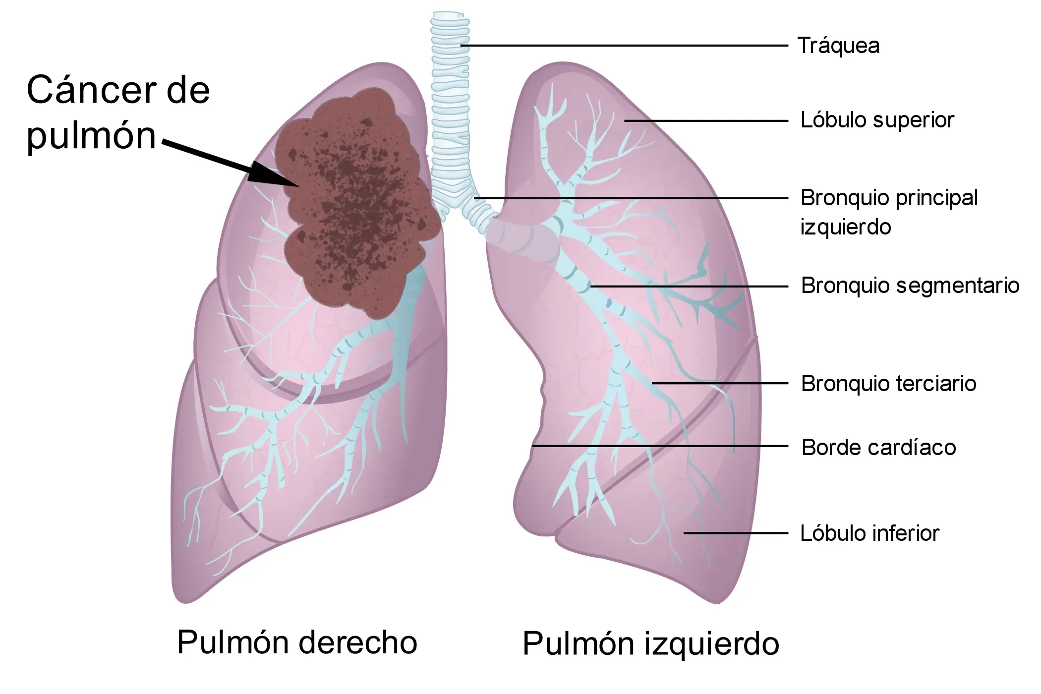 historias reales sobre el cancer de sangre - Cómo se descubre el cáncer en la sangre