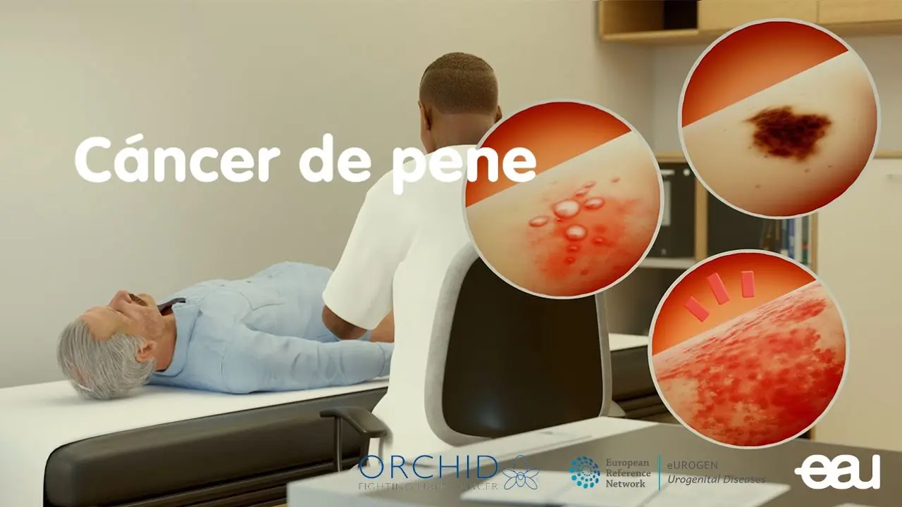 jeydras hechos reales cancer - Cómo se despierta el cáncer de mama